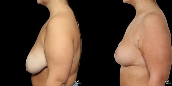 Asymmetry Correction Before & After