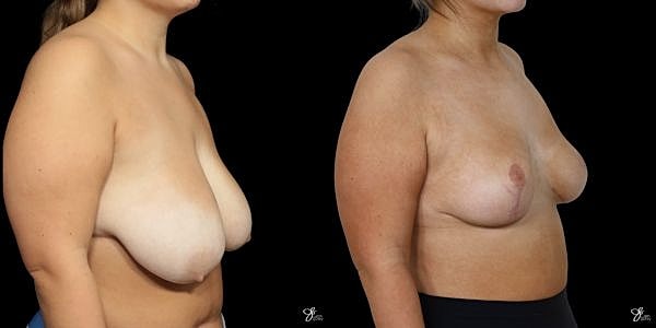Asymmetry Correction Before & After