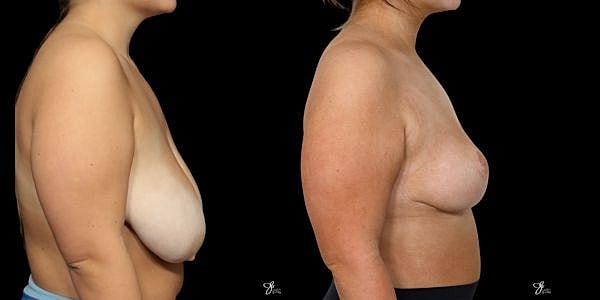 Asymmetry Correction Before & After