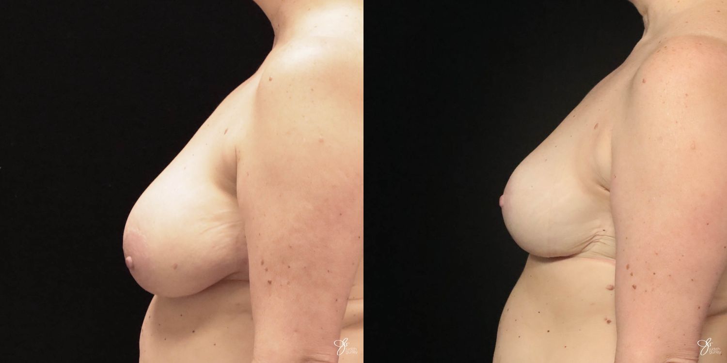 Asymmetry Correction Before & After