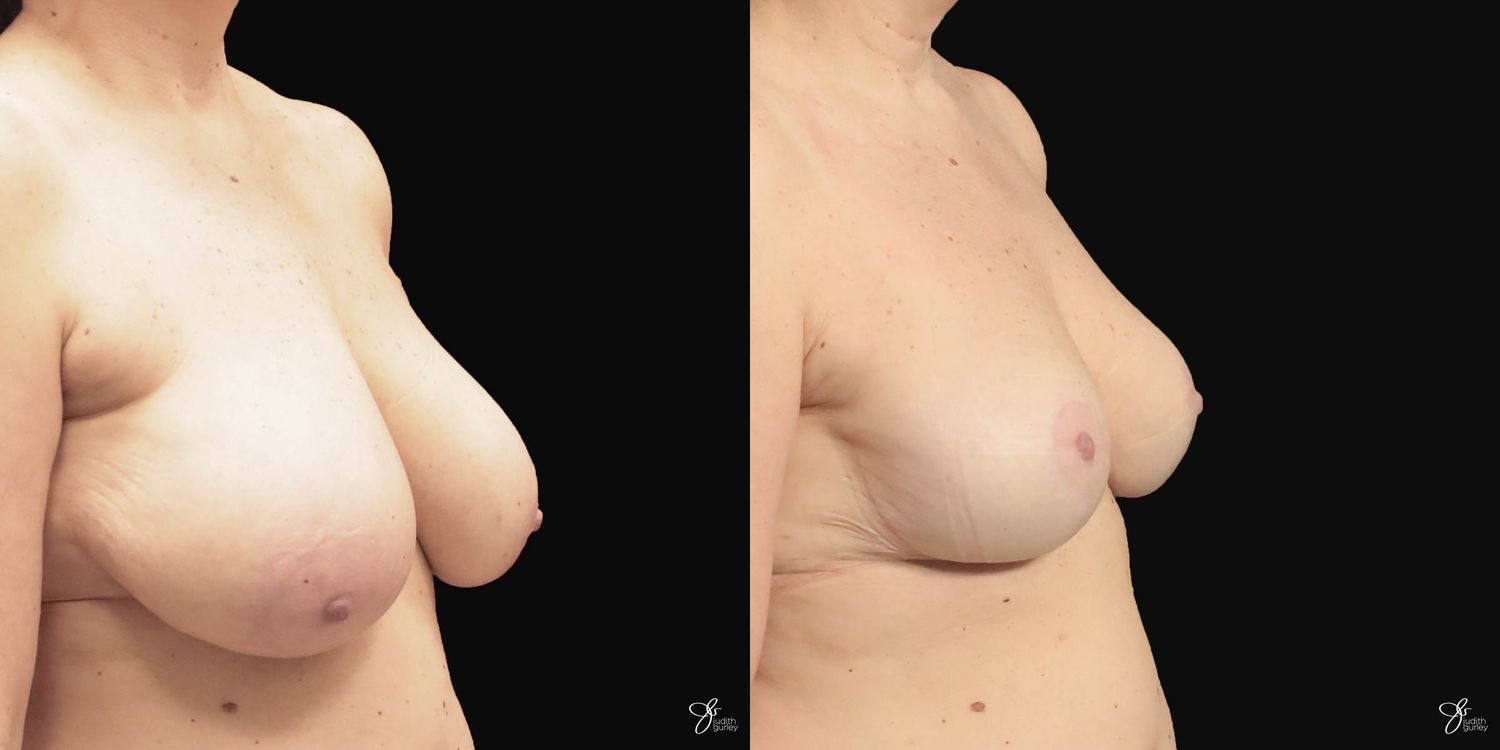 Asymmetry Correction Before & After