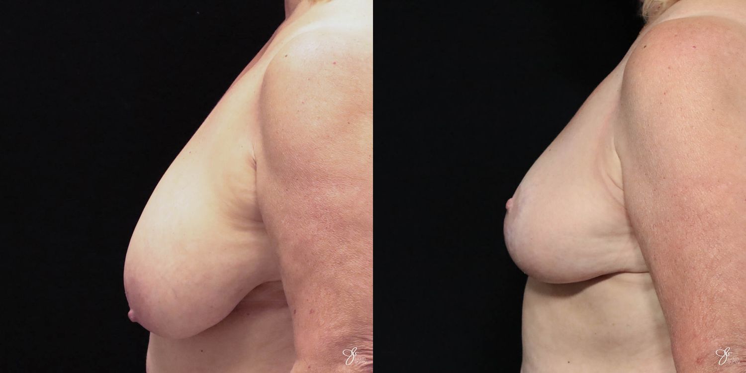 Asymmetry Correction Before & After