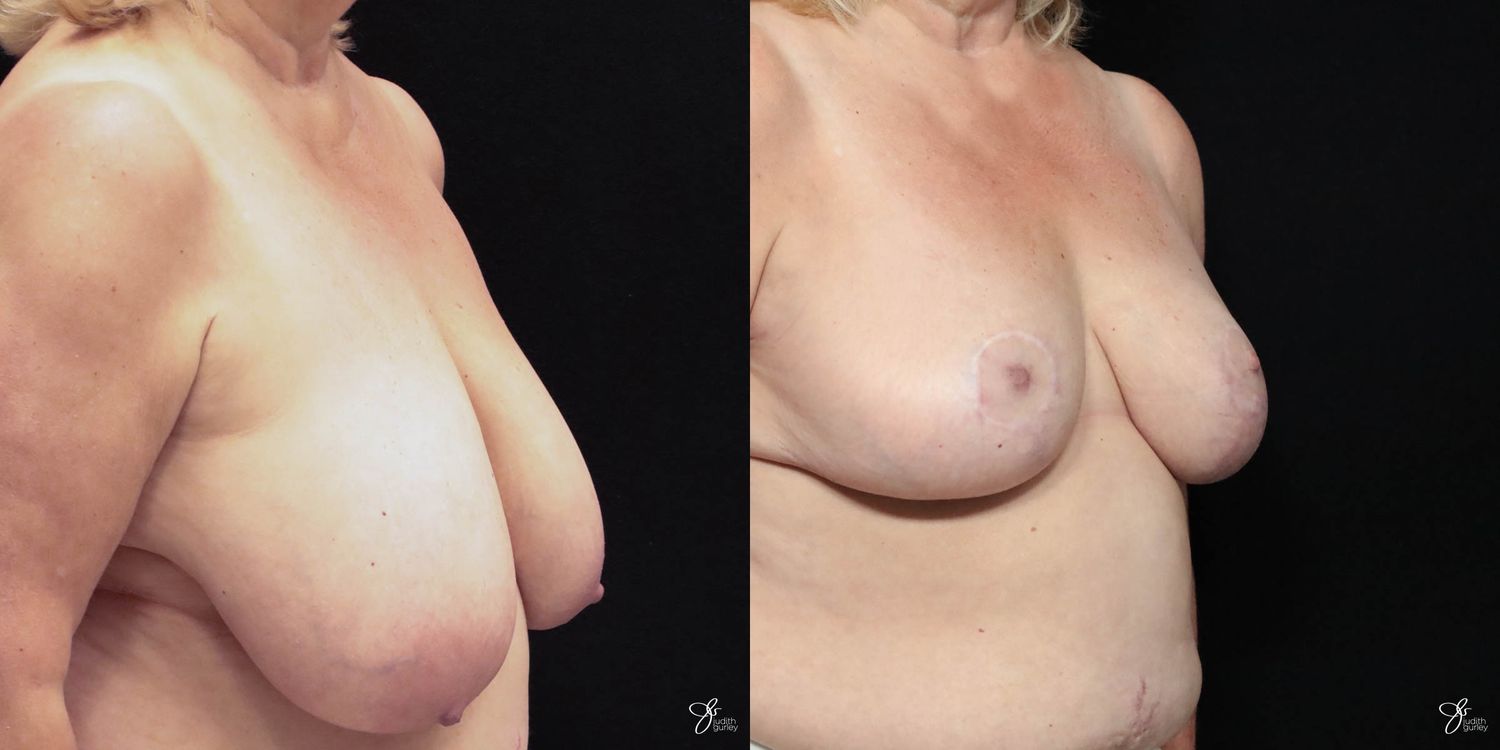 Asymmetry Correction Before & After