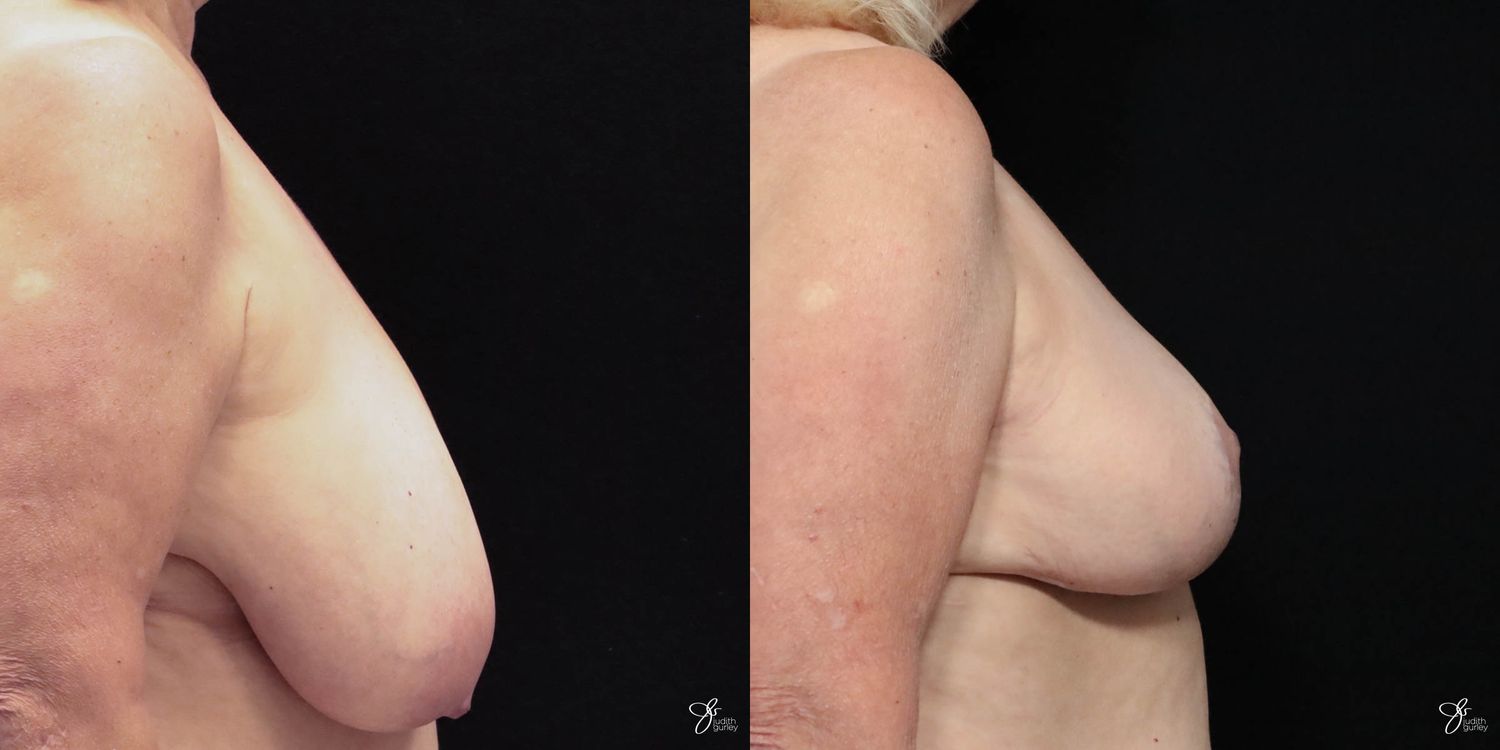 Asymmetry Correction Before & After