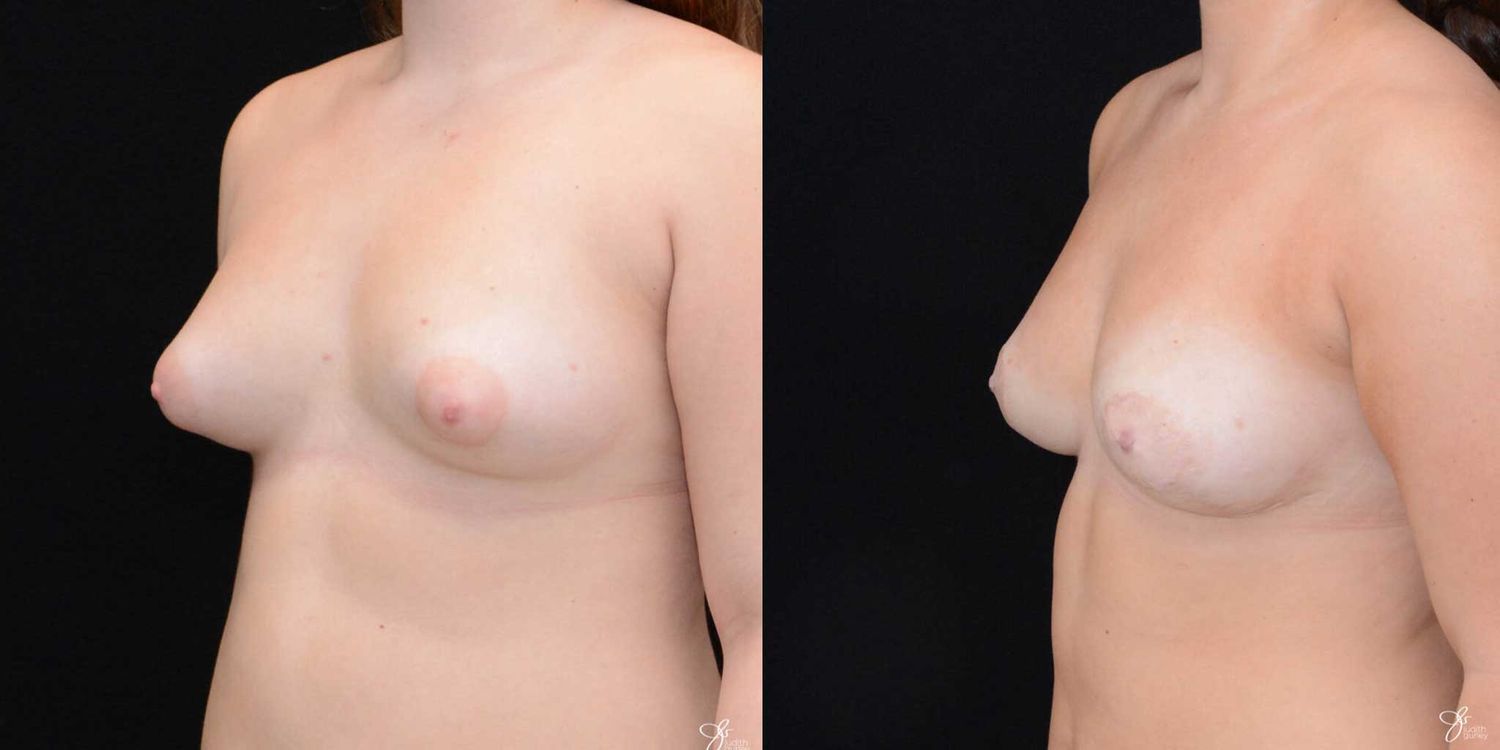 Asymmetry Correction Before & After