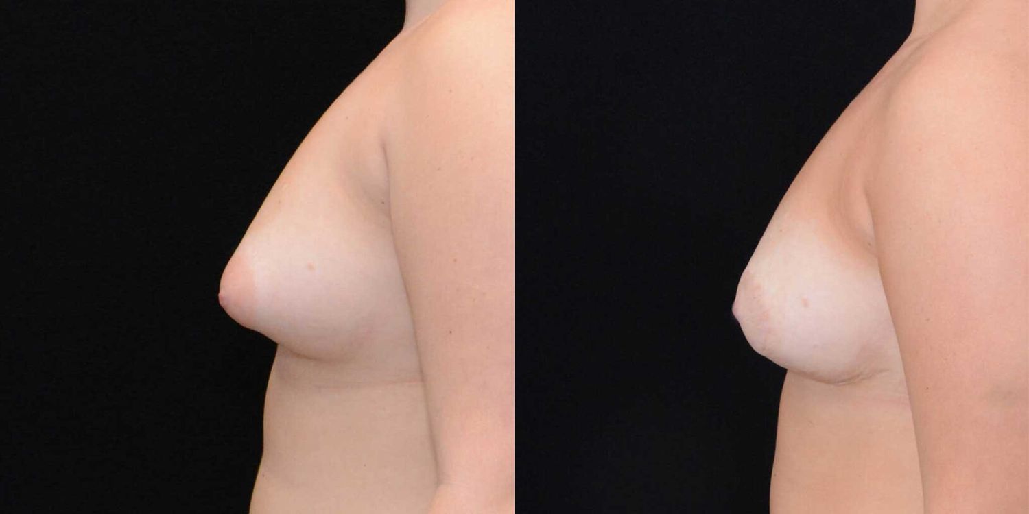 Asymmetry Correction Before & After