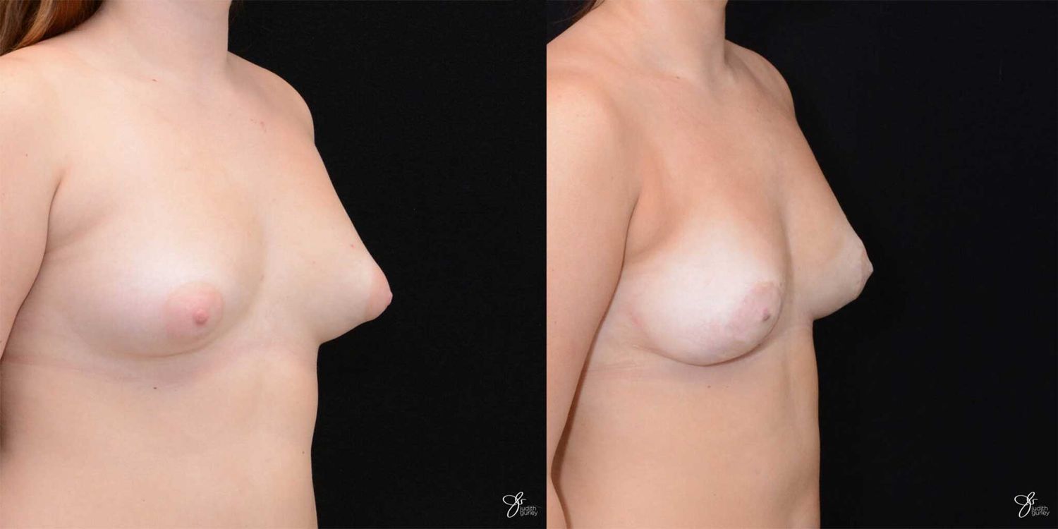 Asymmetry Correction Before & After