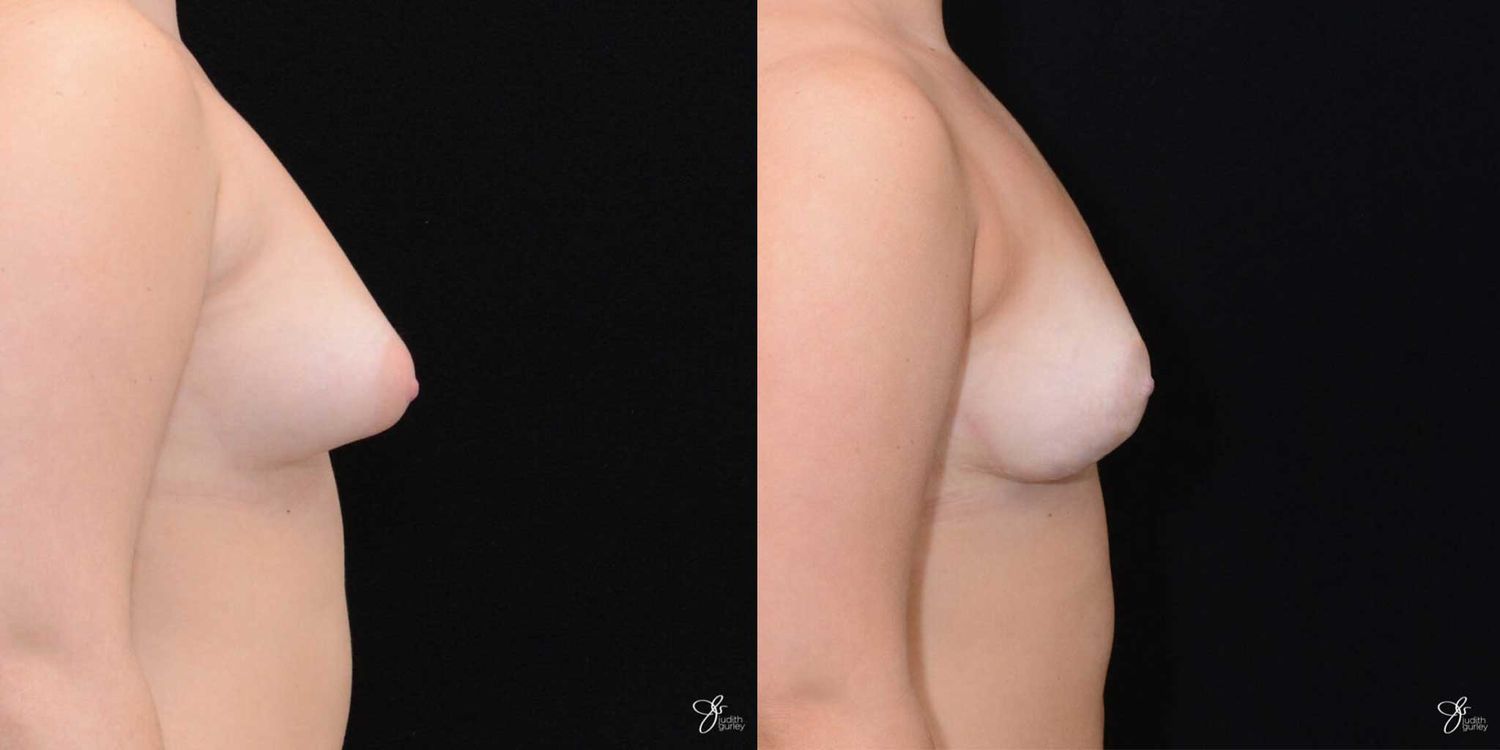 Asymmetry Correction Before & After