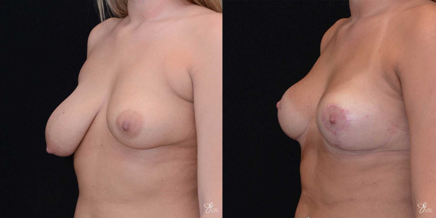 Asymmetry Correction Before & After