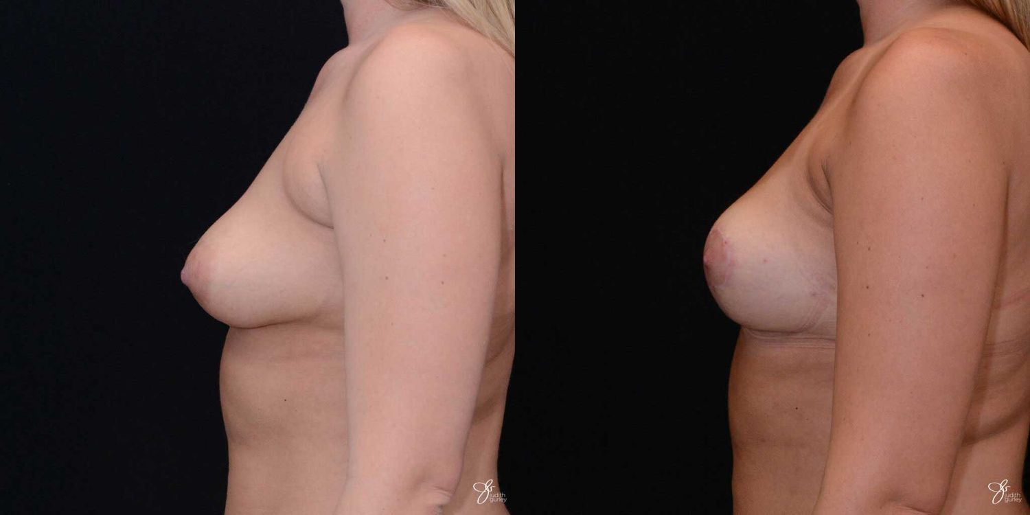 Asymmetry Correction Before & After