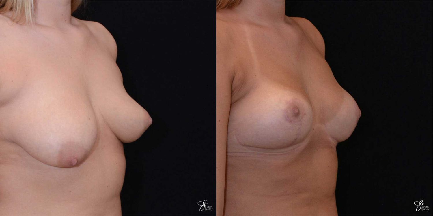 Asymmetry Correction Before & After