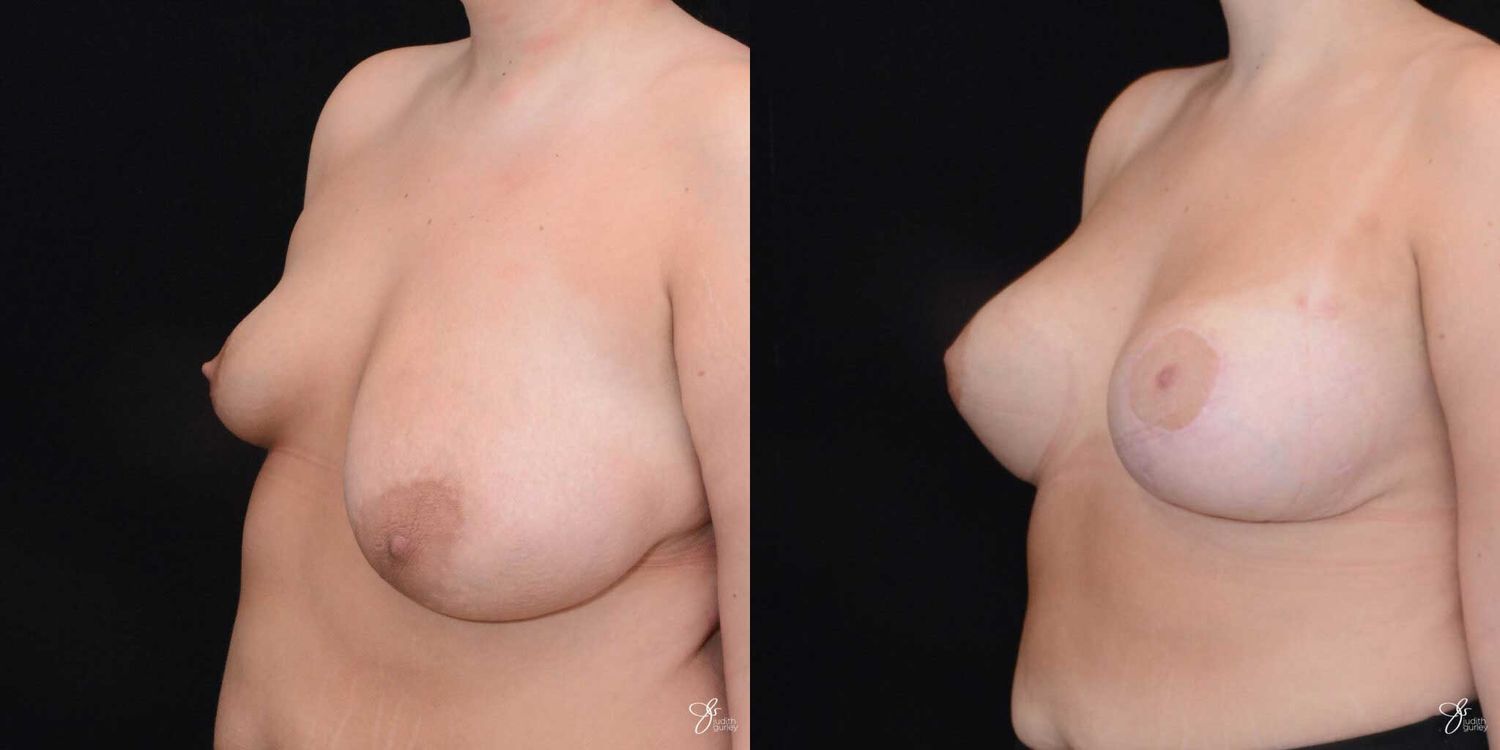 Asymmetry Correction Before & After