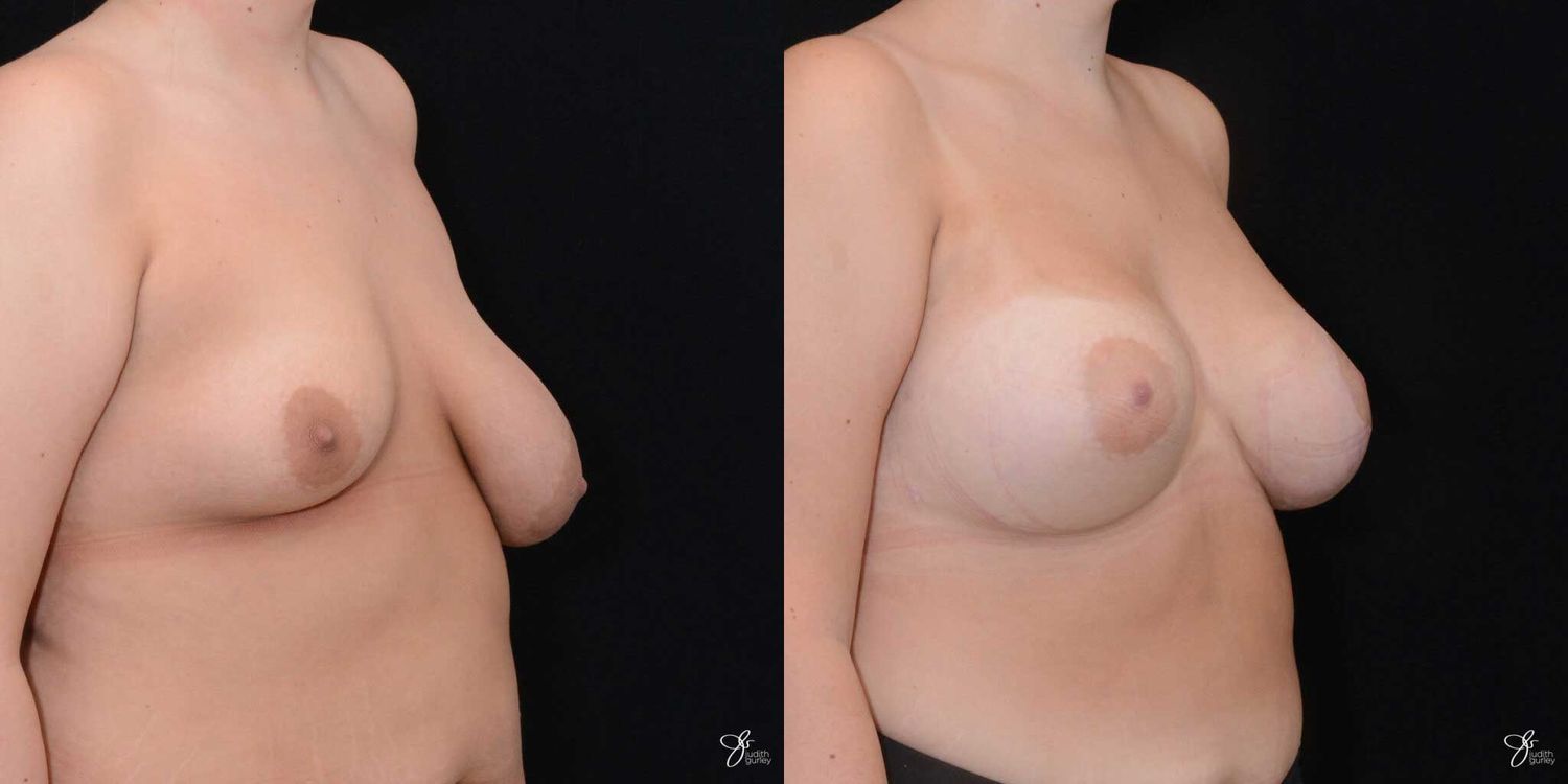 Asymmetry Correction Before & After