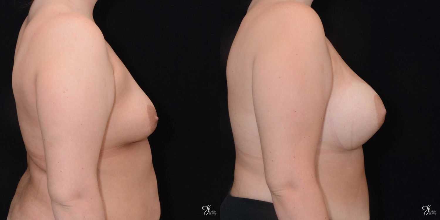 Asymmetry Correction Before & After