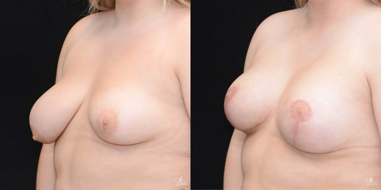 Asymmetry Correction Before & After