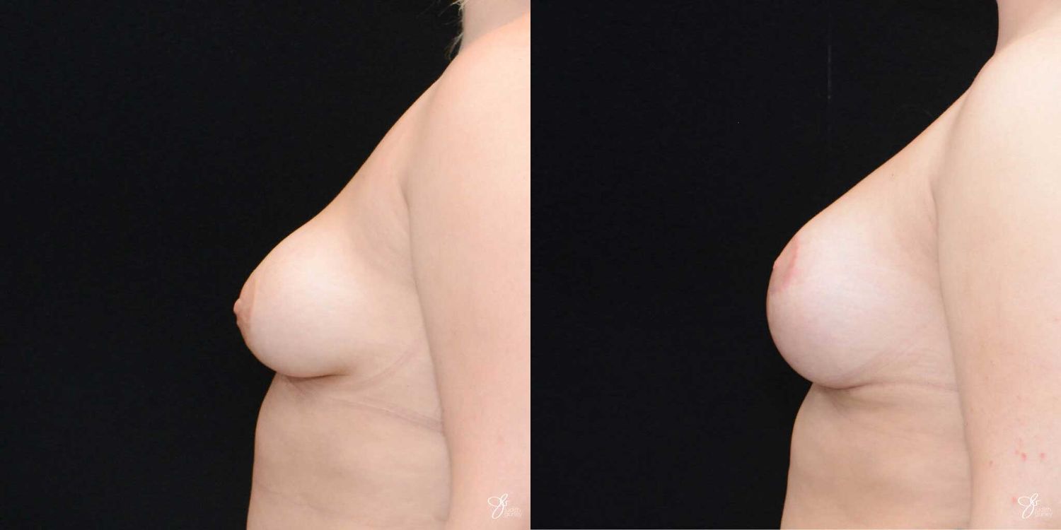 Asymmetry Correction Before & After