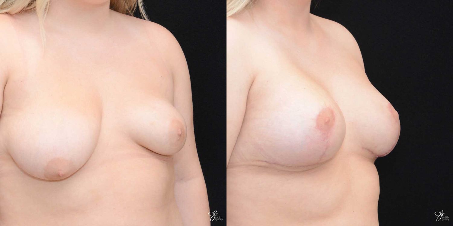 Asymmetry Correction Before & After