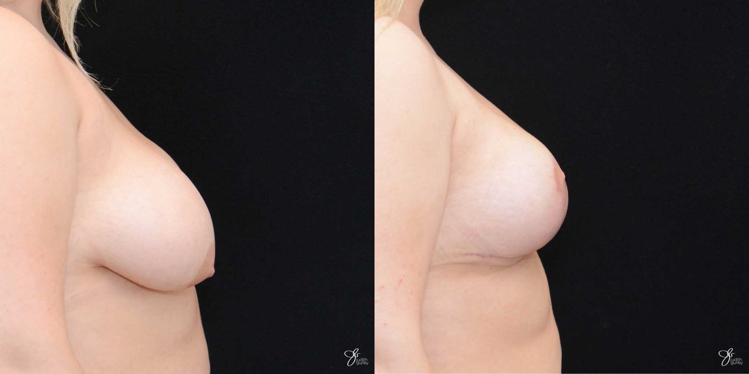 Asymmetry Correction Before & After