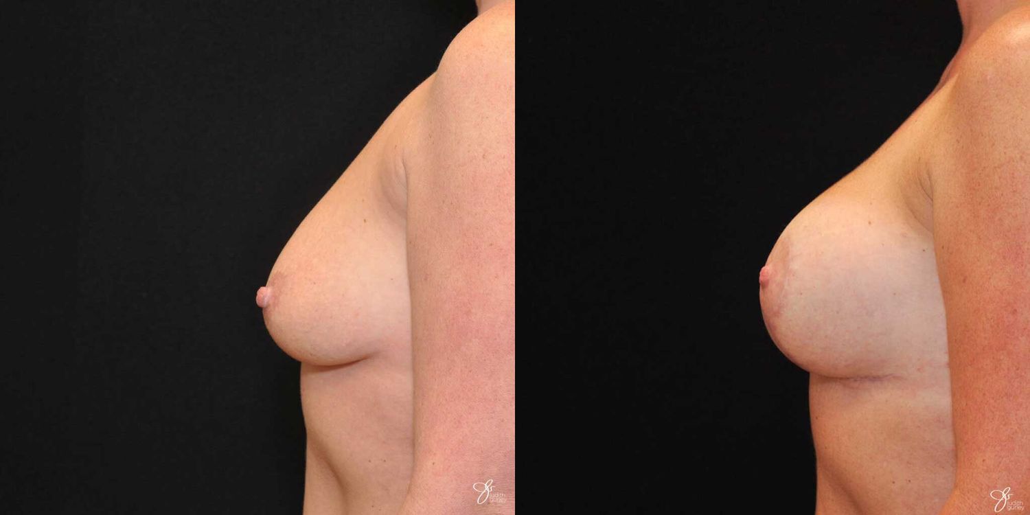 Asymmetry Correction Before & After