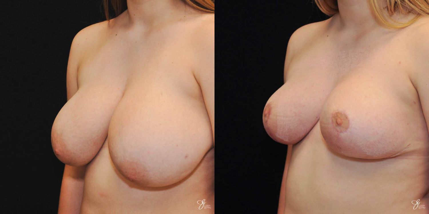 Asymmetry Correction Before & After