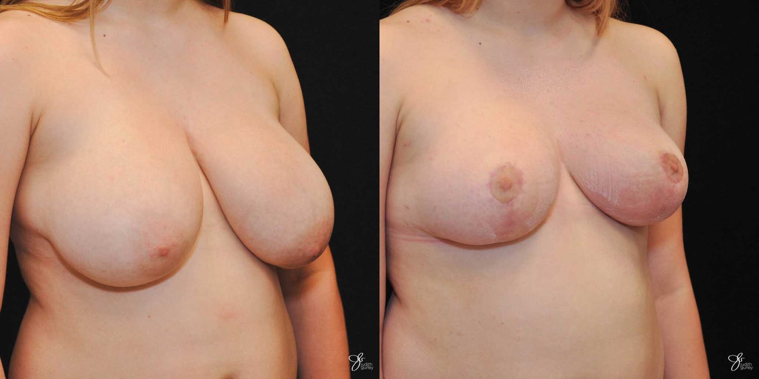 Asymmetry Correction Before & After