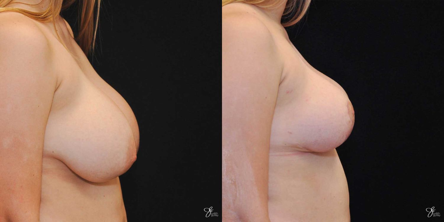 Asymmetry Correction Before & After