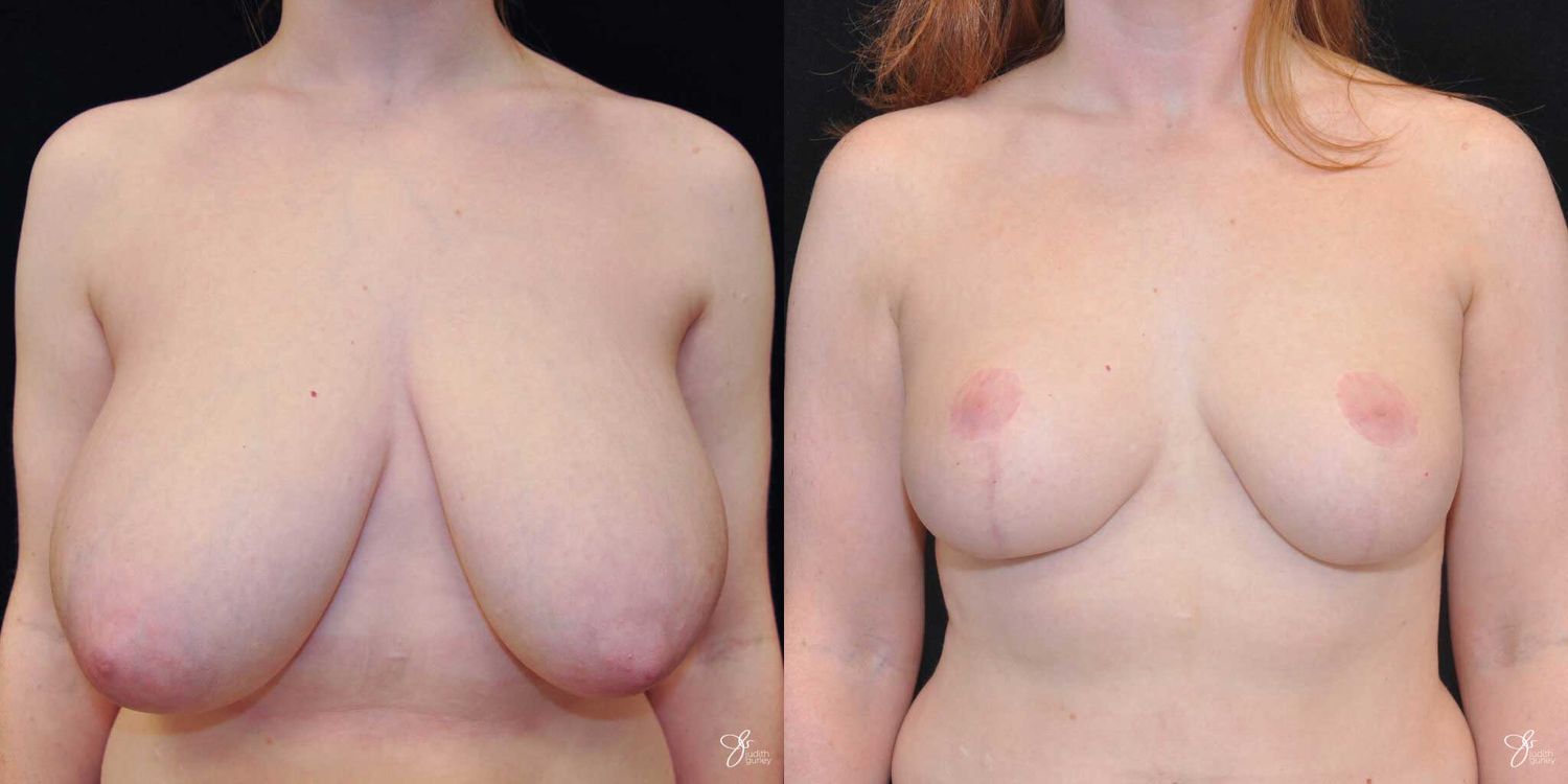 Asymmetry Correction Before & After