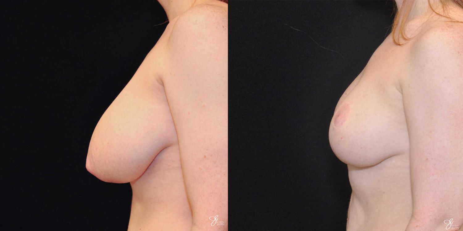 Asymmetry Correction Before & After