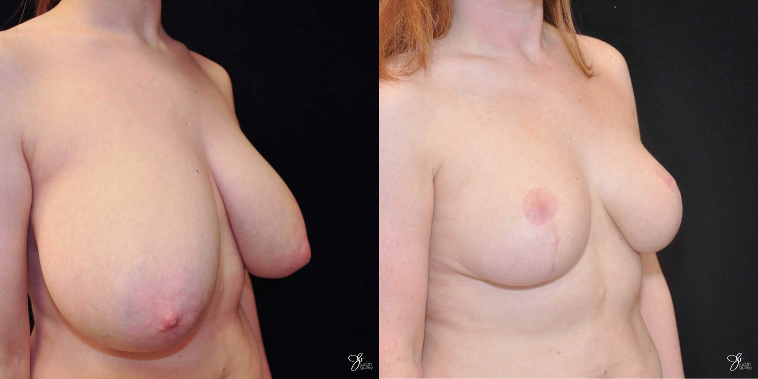 Asymmetry Correction Before & After