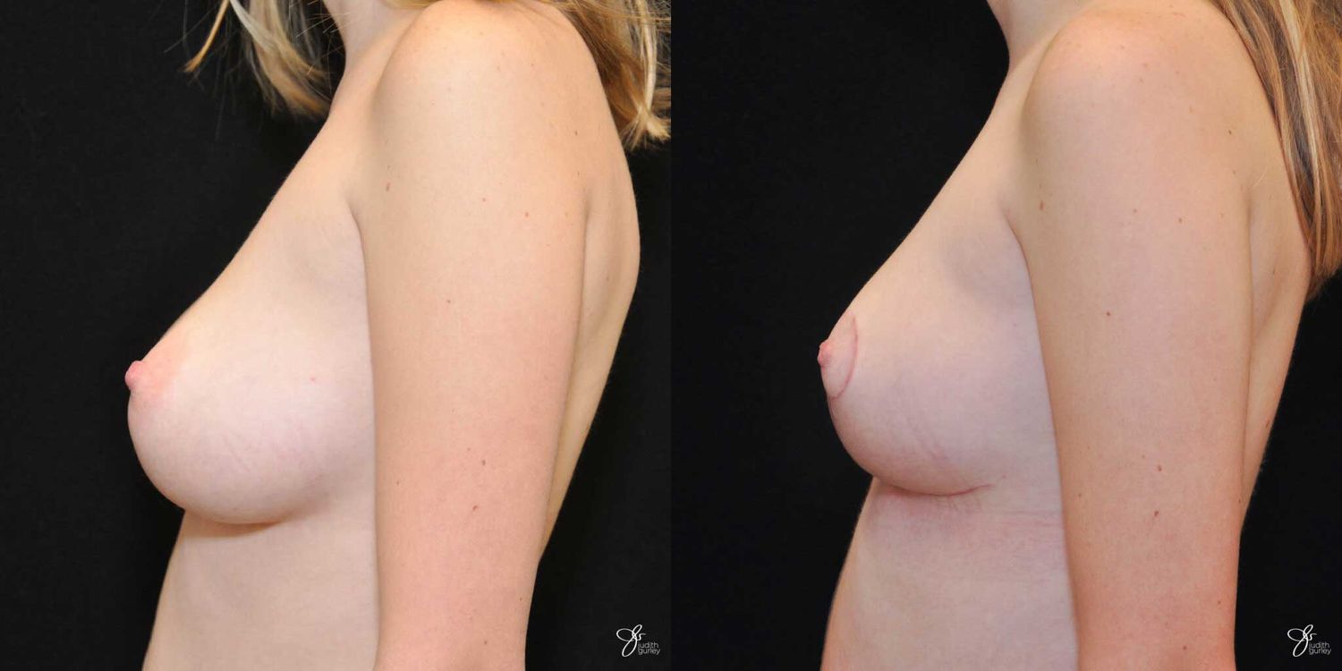 Asymmetry Correction Before & After