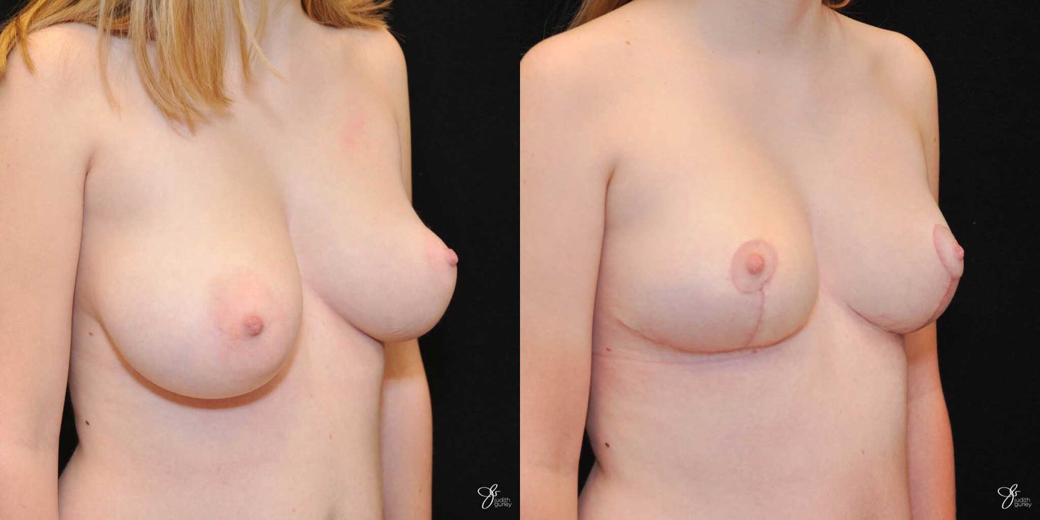 Asymmetry Correction Before & After