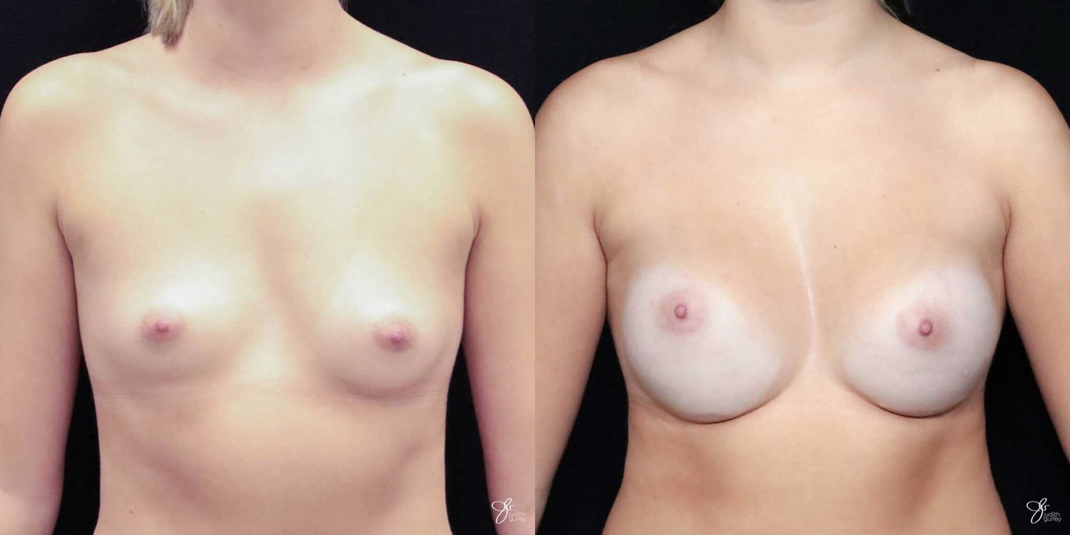 Asymmetry Correction Before & After