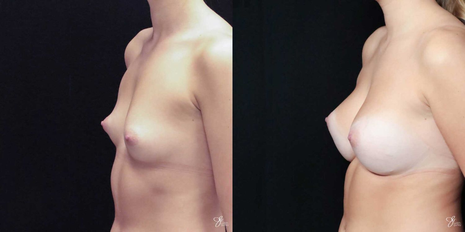 Asymmetry Correction Before & After