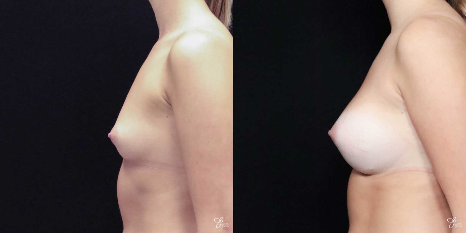 Asymmetry Correction Before & After