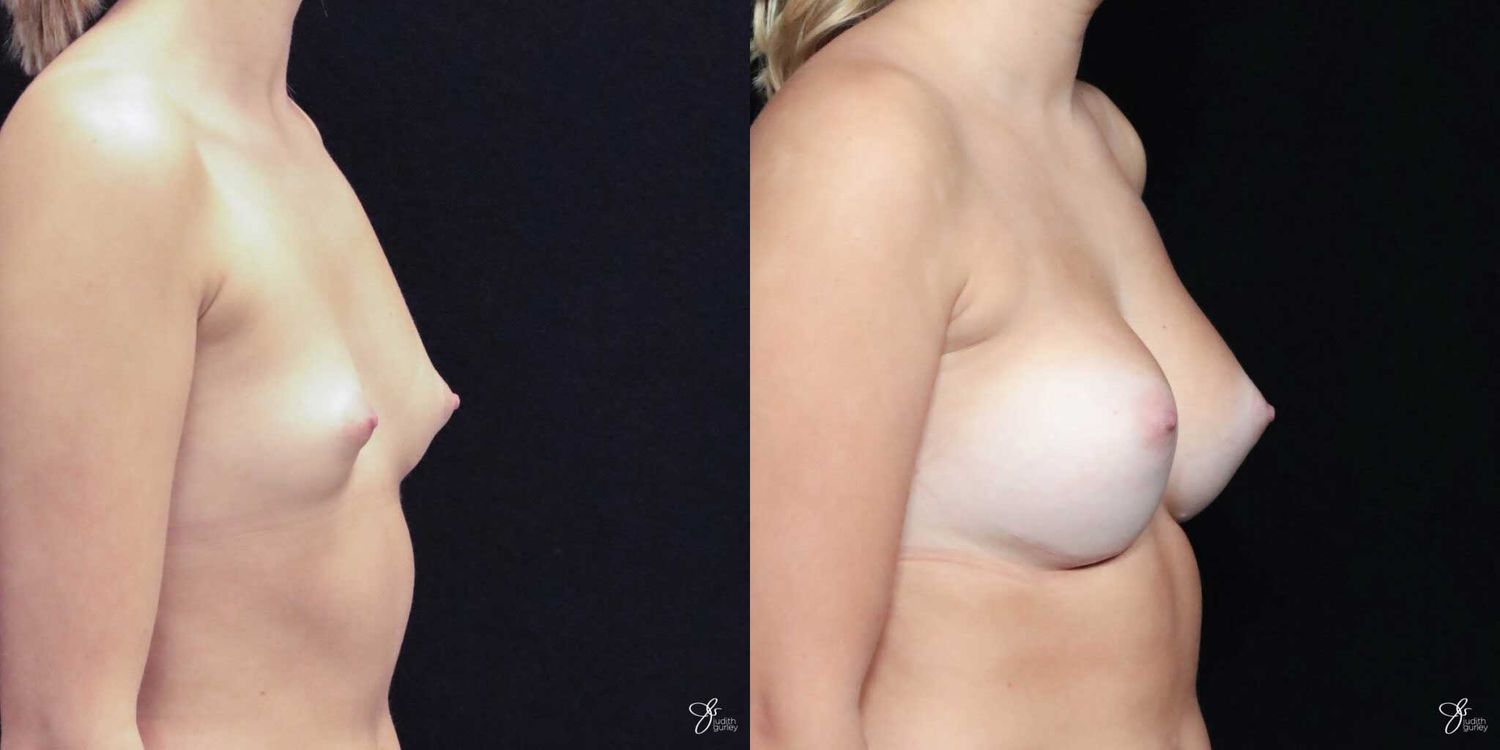 Asymmetry Correction Before & After