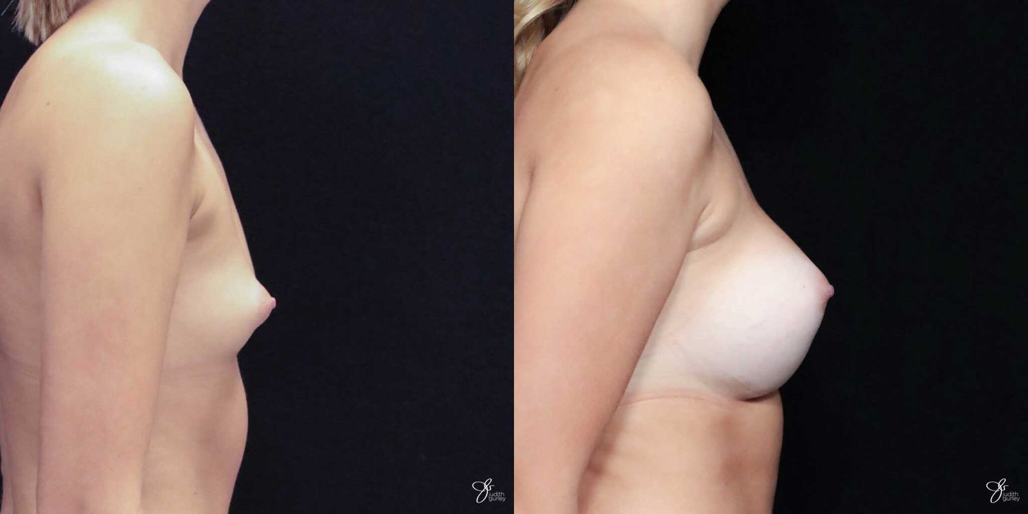 Asymmetry Correction Before & After