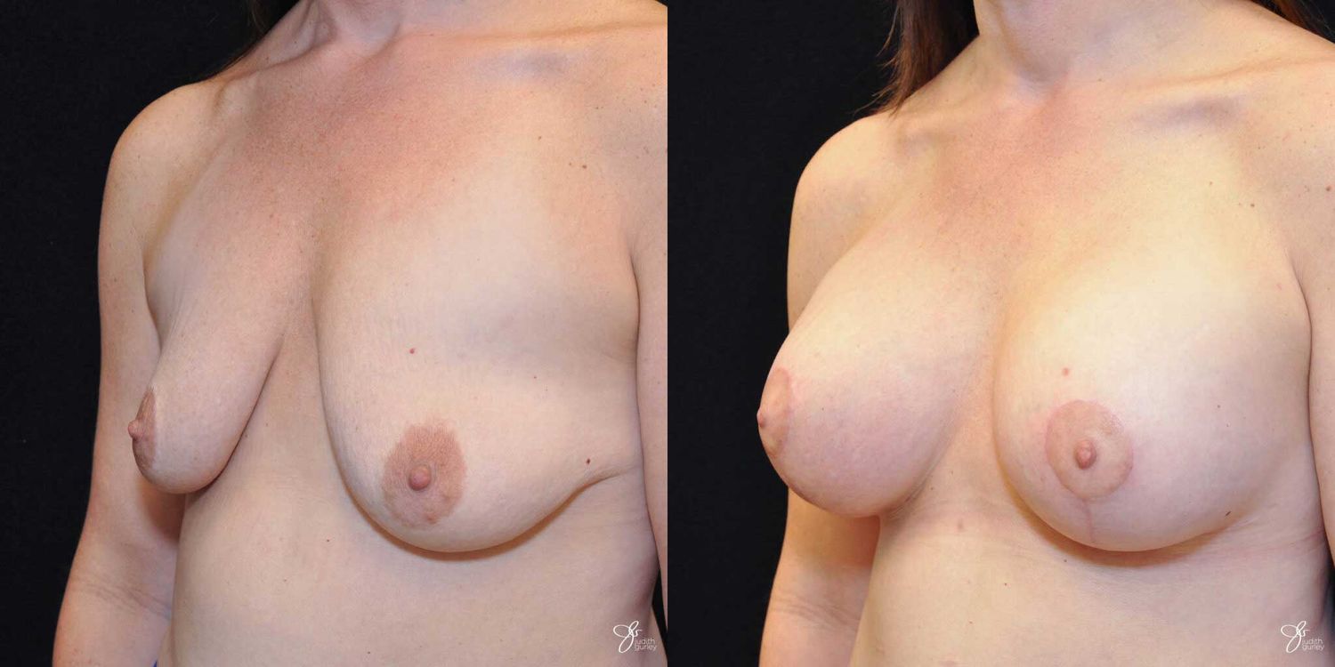 Asymmetry Correction Before & After