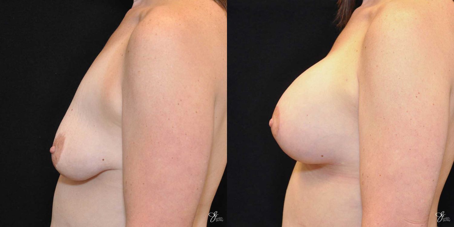 Asymmetry Correction Before & After