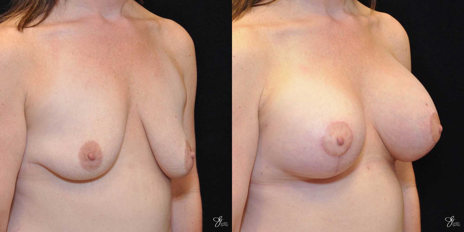 Asymmetry Correction Before & After