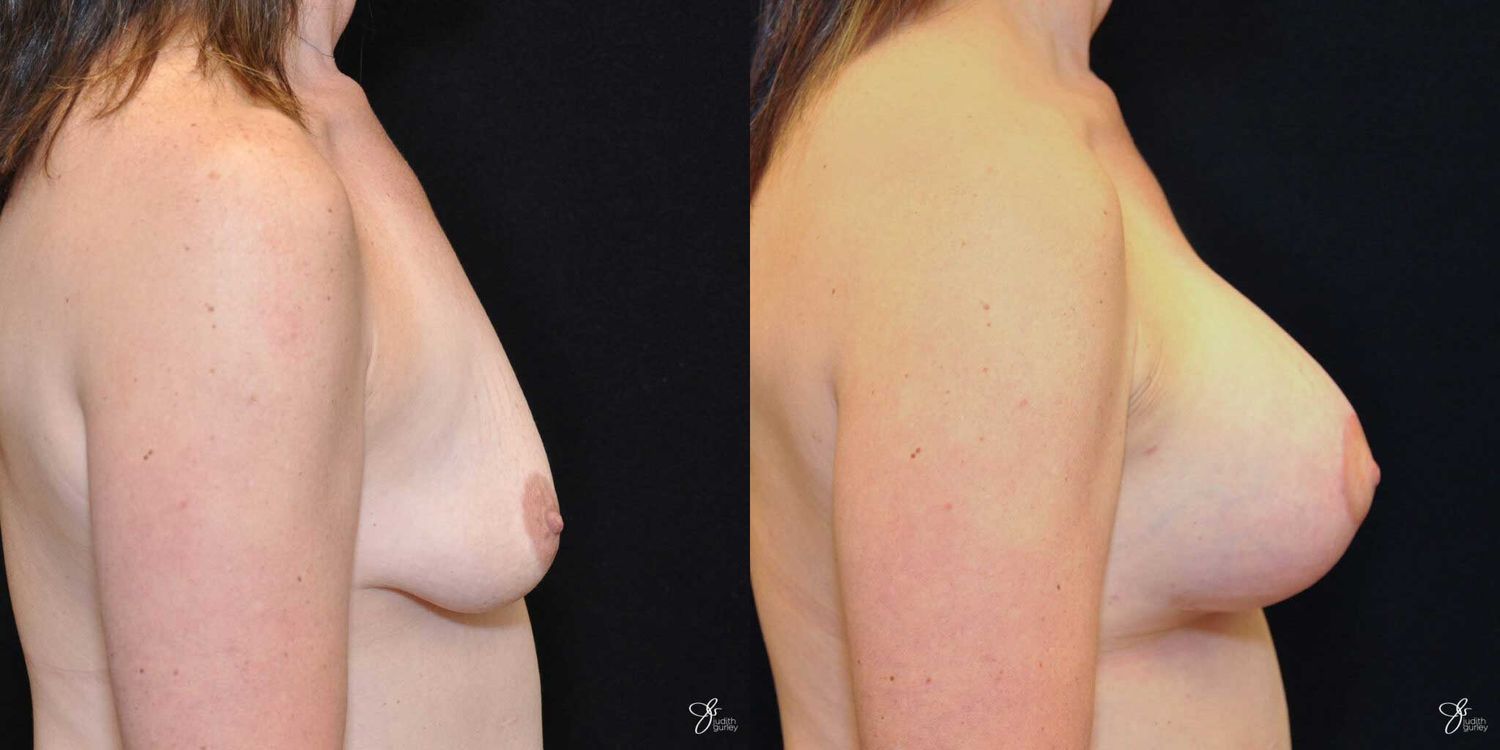 Asymmetry Correction Before & After