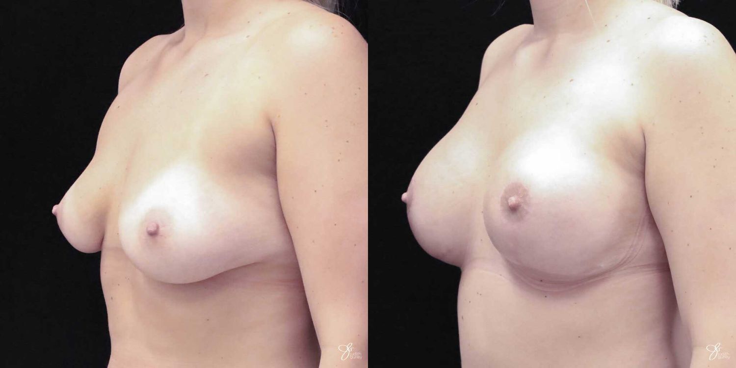 Asymmetry Correction Before & After