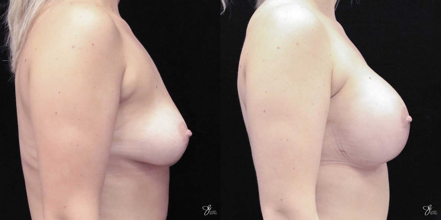 Asymmetry Correction Before & After