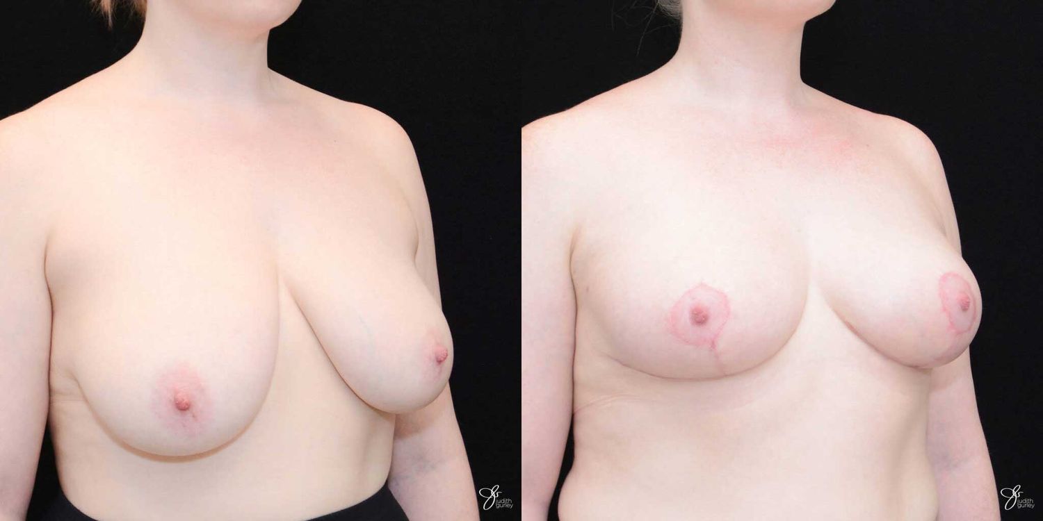 Asymmetry Correction Before & After