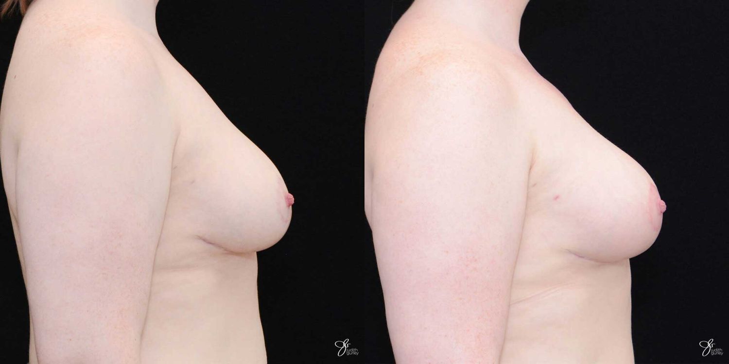 Asymmetry Correction Before & After