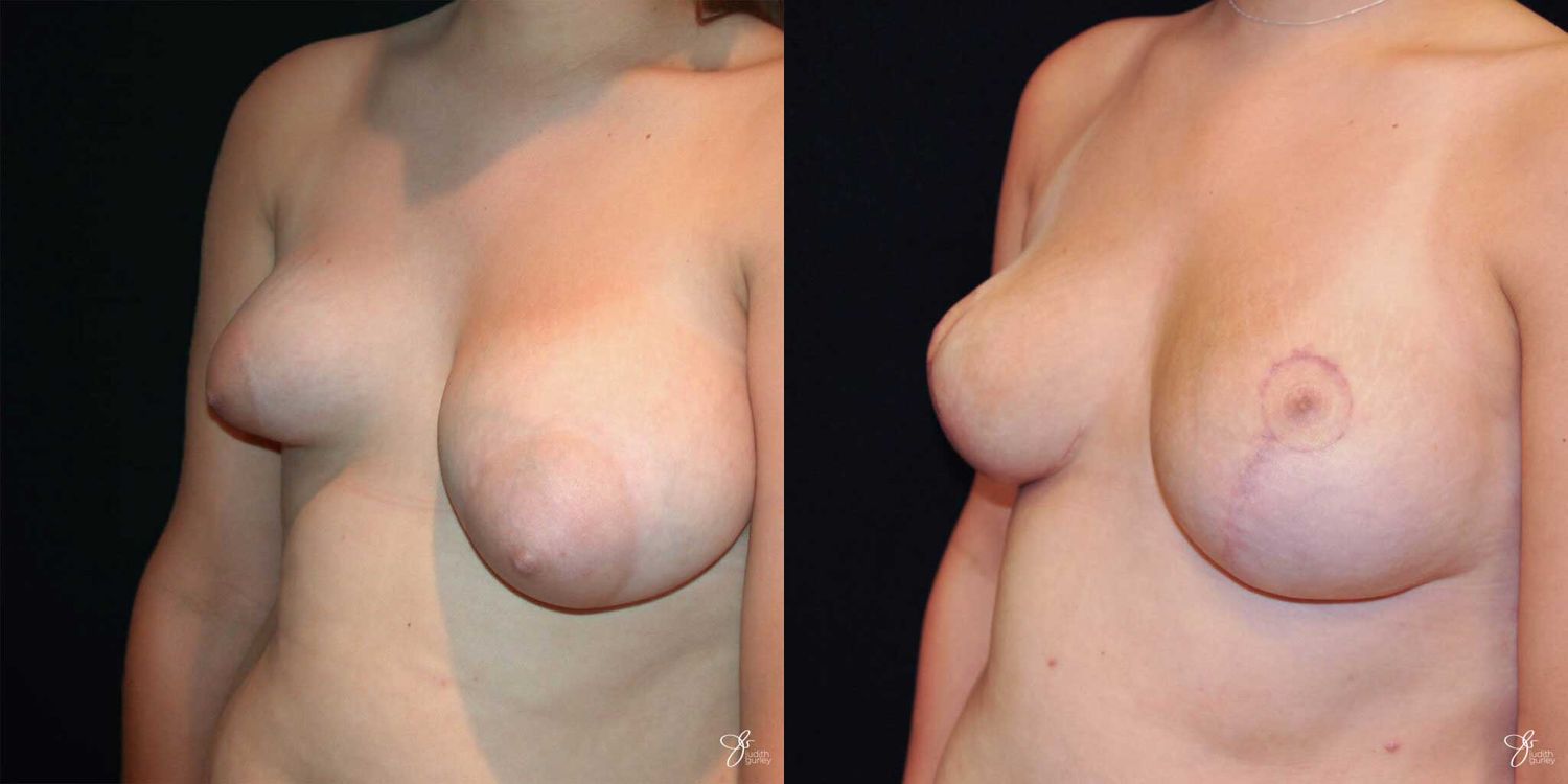 Asymmetry Correction Before & After