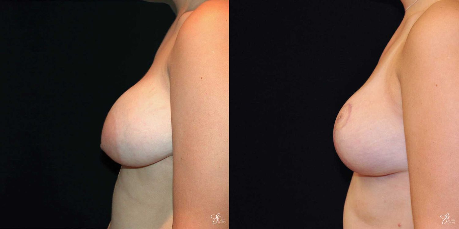 Asymmetry Correction Before & After