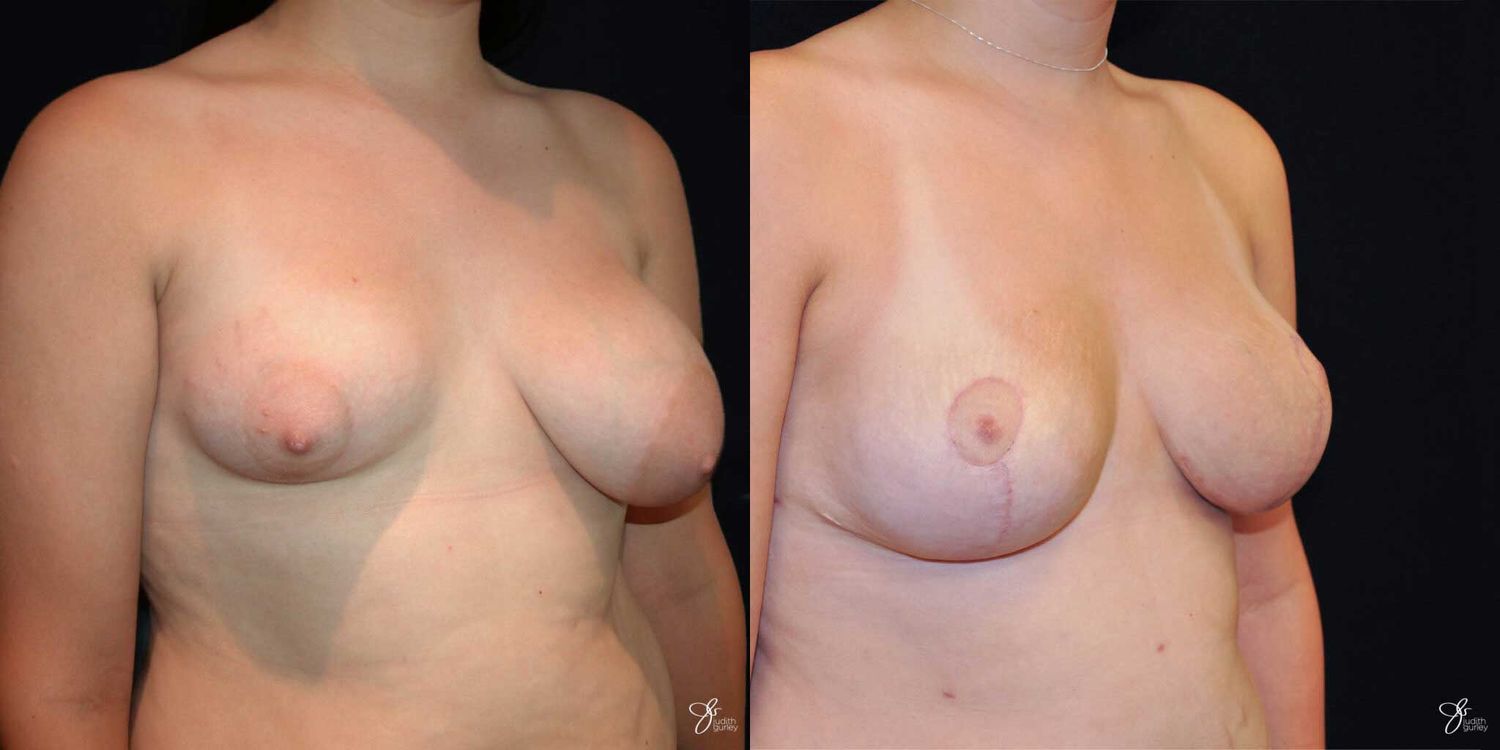 Asymmetry Correction Before & After