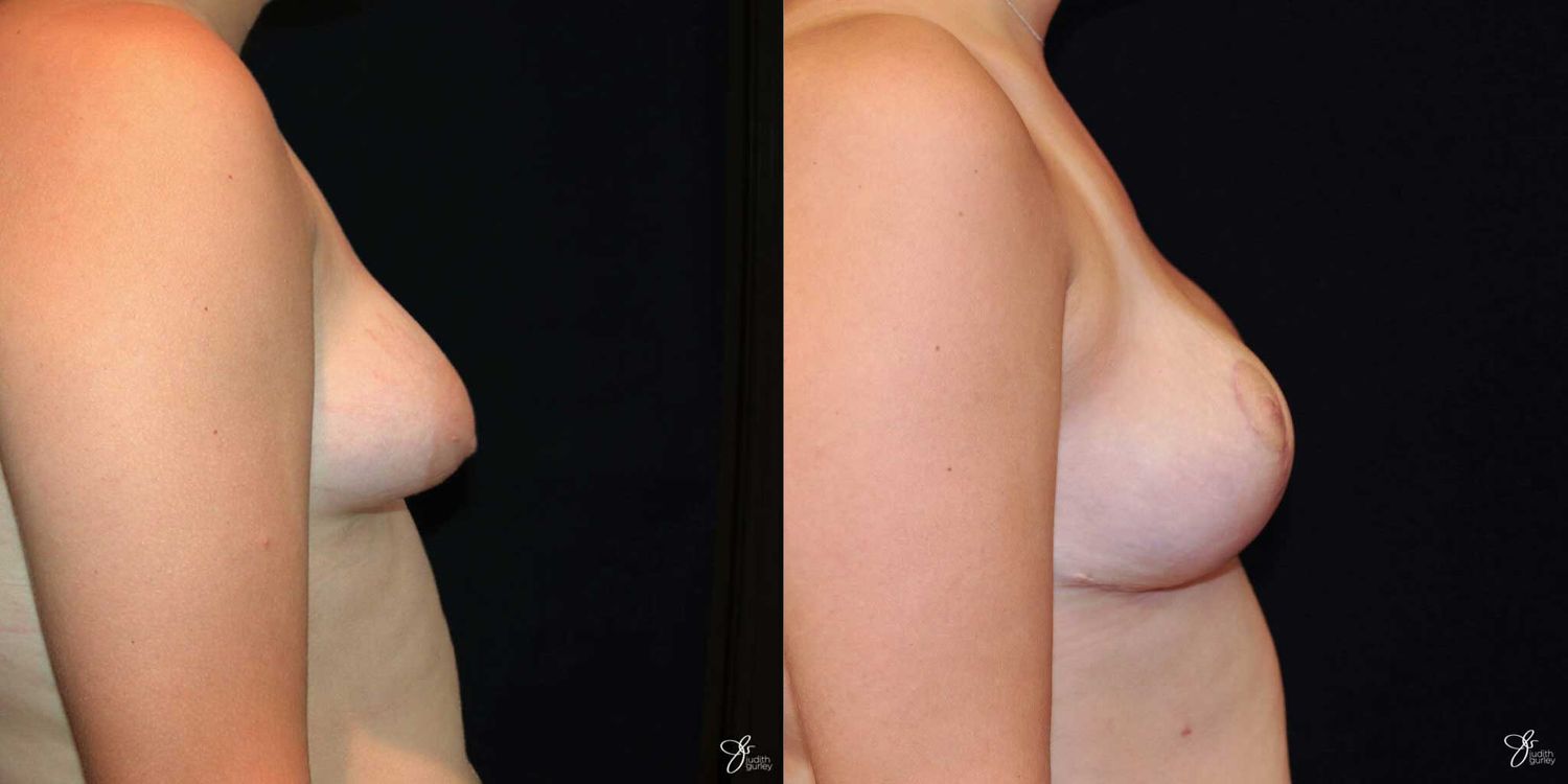 Asymmetry Correction Before & After