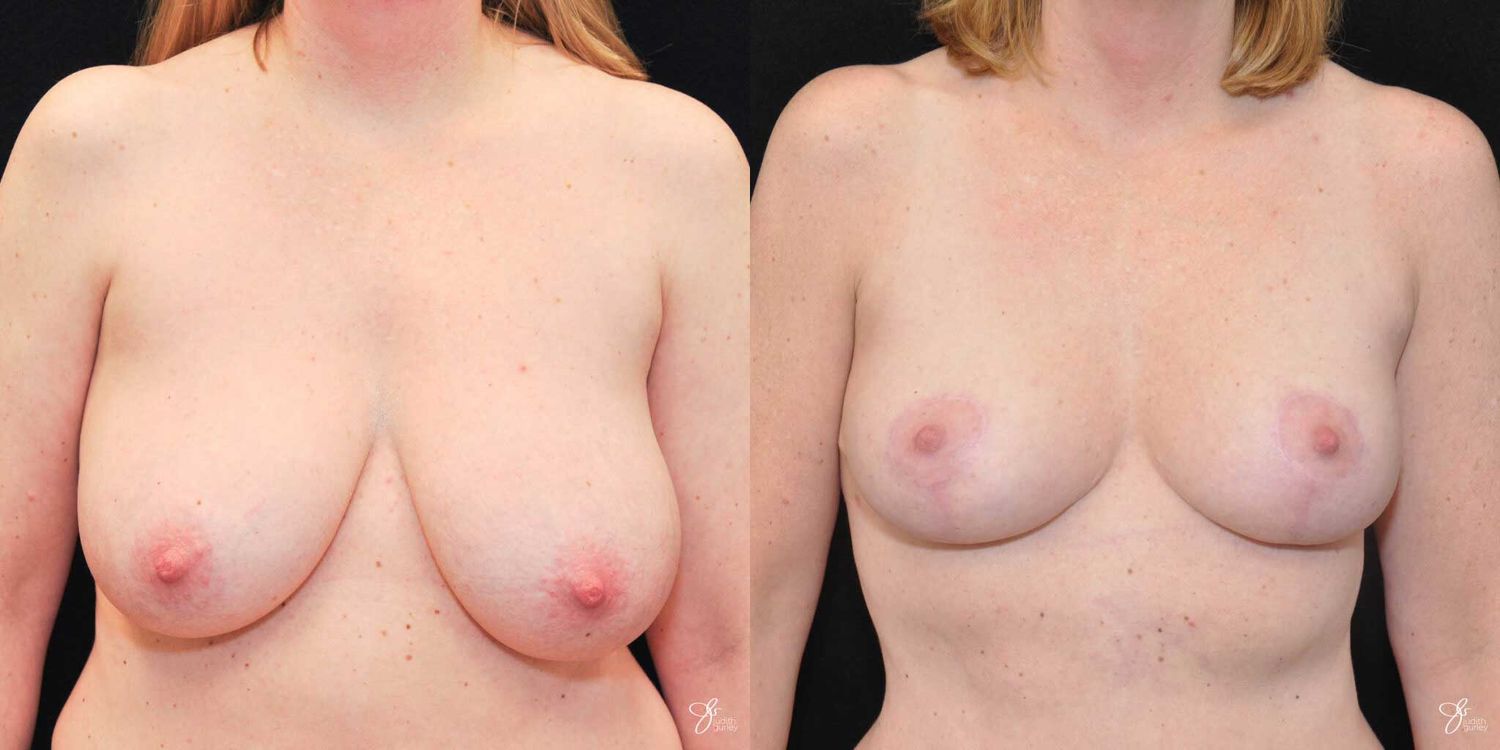 Asymmetry Correction Before & After