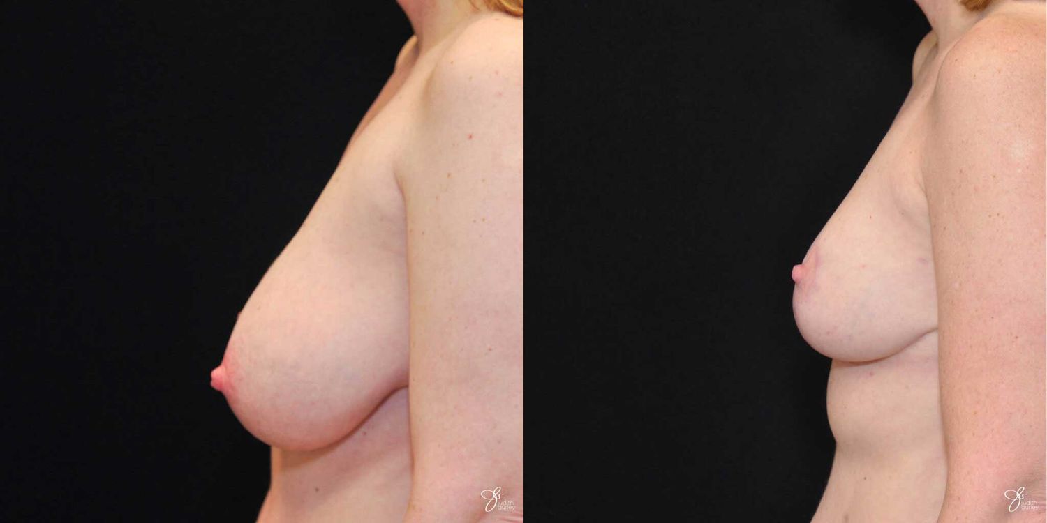 Asymmetry Correction Before & After